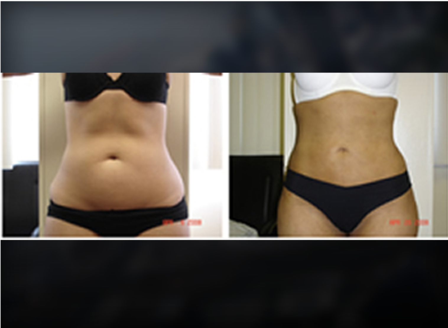Abdomen before and after