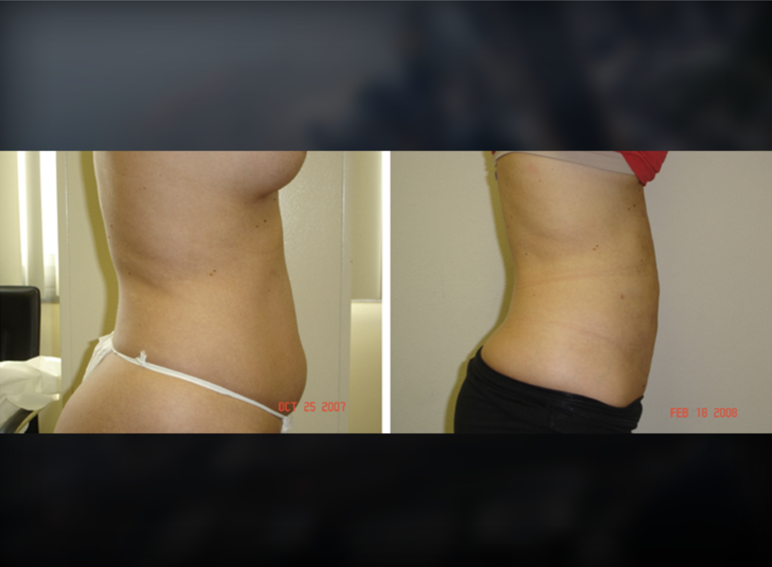 Flanks before and after