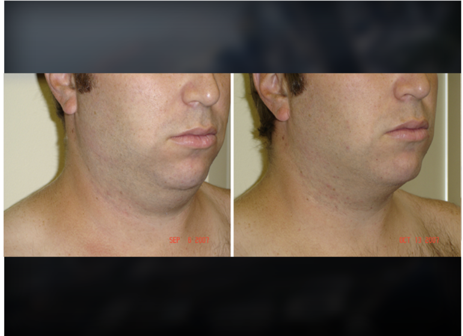 Jawline before and after